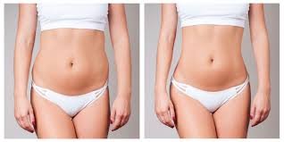 How BodyTite Liposuction Helps Achieve a Sculpted Silhouette?